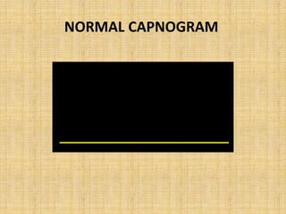 NORMAL TIME CAPNOGRAM




   I II   III   IV
 