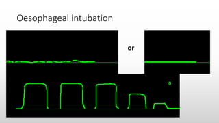 Capnography | PPTX