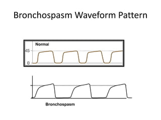 Bronchospasm Waveform Pattern
45
0
Normal
Bronchospasm
 