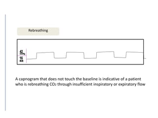 Rebreathing
A capnogram that does not touch the baseline is indicative of a patient
who is rebreathing CO2 through insufficient inspiratory or expiratory flow
 