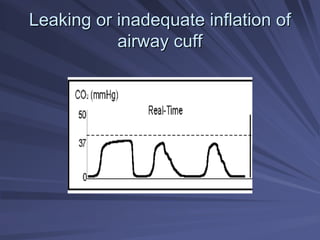 Leaking or inadequate inflation of
Leaking or inadequate inflation of
airway cuff
airway cuff
 