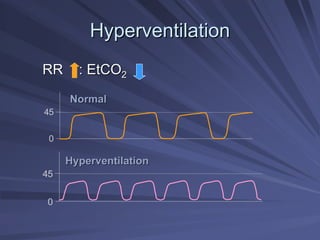 45
0
Hyperventilation
Hyperventilation
RR : EtCO
RR : EtCO2
2
45
0
Normal
Normal
Hyperventilation
Hyperventilation
 