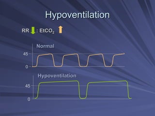 Hypoventilation
Hypoventilation
45
0
45
0
RR : EtCO
RR : EtCO2
2
Normal
Normal
Hypoventilation
Hypoventilation
 