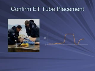 Confirm ET Tube Placement
Confirm ET Tube Placement
45
0
 