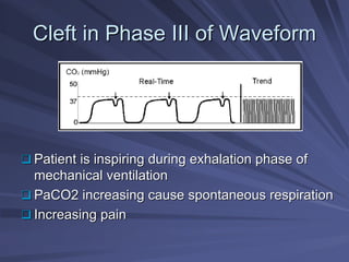 Cleft in Phase III of Waveform
Cleft in Phase III of Waveform
‰
‰ Patient is inspiring during exhalation phase of
Patient is inspiring during exhalation phase of
mechanical ventilation
mechanical ventilation
‰
‰ PaCO2 increasing cause spontaneous respiration
PaCO2 increasing cause spontaneous respiration
‰
‰ Increasing pain
Increasing pain
 