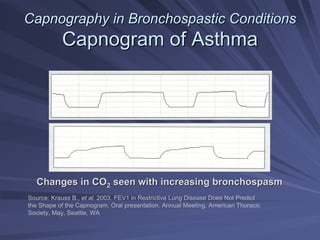 Capnography in
Capnography in Bronchospastic
Bronchospastic Conditions
Conditions
Capnogram of Asthma
Capnogram of Asthma
Source: Krauss B., et al. 2003. FEV1 in Restrictive Lung Disease Does Not Predict
the Shape of the Capnogram. Oral presentation. Annual Meeting, American Thoracic
Society, May, Seattle, WA
Changes in CO
Changes in CO2
2 seen with increasing bronchospasm
seen with increasing bronchospasm
Bronchospasm
Normal
 