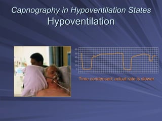 Capnography in Hypoventilation States
Capnography in Hypoventilation States
Hypoventilation
Hypoventilation
45
35
0
25
55
65
Time condensed; actual rate is slower
Time condensed; actual rate is slower
 