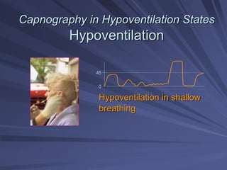 Capnography in Hypoventilation States
Capnography in Hypoventilation States
Hypoventilation
Hypoventilation
45
0
Hypoventilation in shallow
Hypoventilation in shallow
breathing
breathing
 