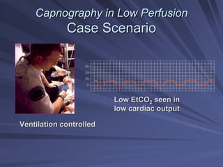Capnography in Low Perfusion
Capnography in Low Perfusion
Case Scenario
Case Scenario
45
35
0
25
Low EtCO
Low EtCO2
2 seen in
seen in
low cardiac output
low cardiac output
Ventilation controlled
Ventilation controlled
 