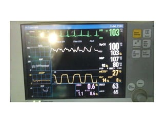 Capnography 