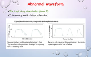 Abnormal waveform
The inspiratory downstroke (phase 0).
It is a nearly vertical drop to baseline.
 