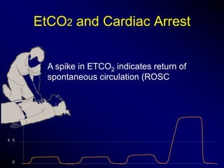 Capnography in icu | PPTX