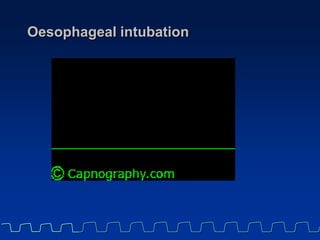 Cardiogenic oscillations.
• Ripple effect,
superimposed on
the plateau and the
descending limb,
resulting from
small gas
m...