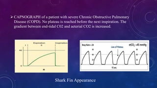 Shark Fin Appearance
CAPNOGRAPH of a patient with severe Chronic Obstructive Pulmonary
Disease (COPD). No plateau is reac...