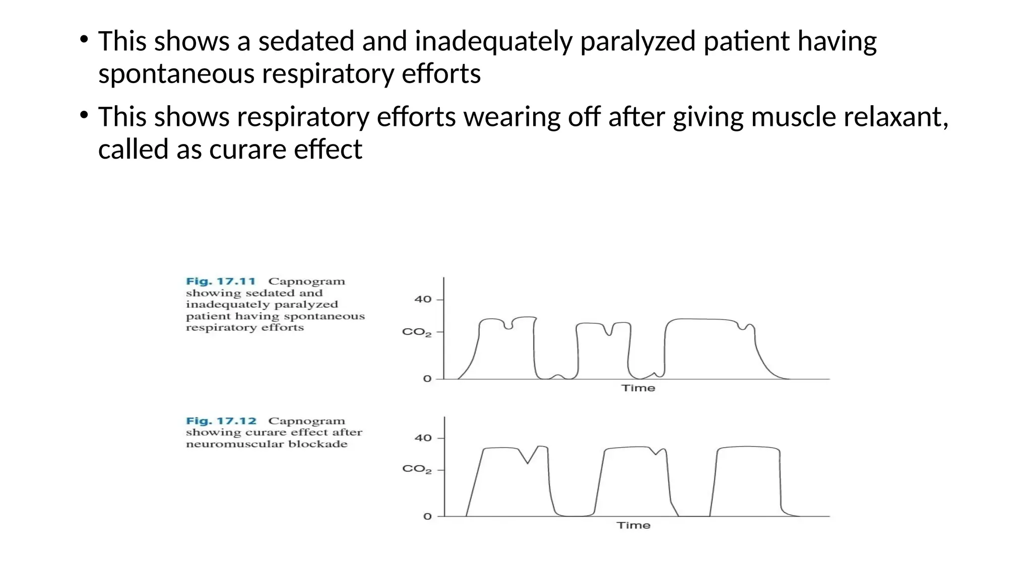 • This shows a sedated and inadequately paralyzed patient having
spontaneous respiratory efforts
• This shows respiratory efforts wearing off after giving muscle relaxant,
called as curare effect
 