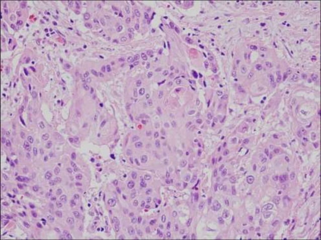 Cap protocol bladder | PPTX