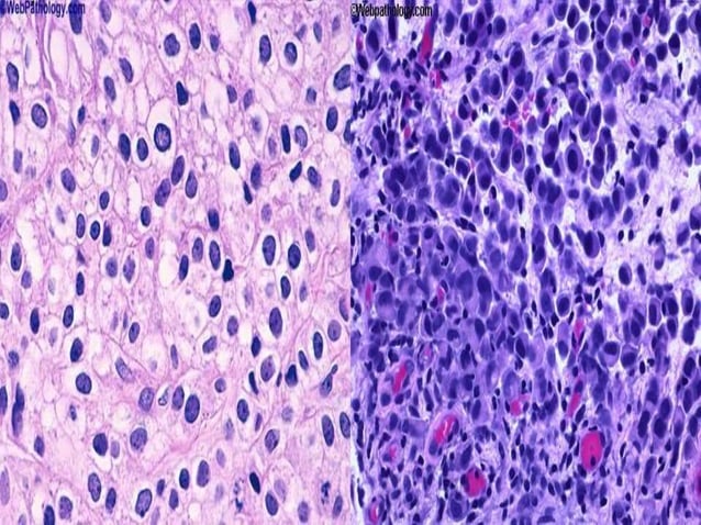 Cap protocol bladder | PPTX