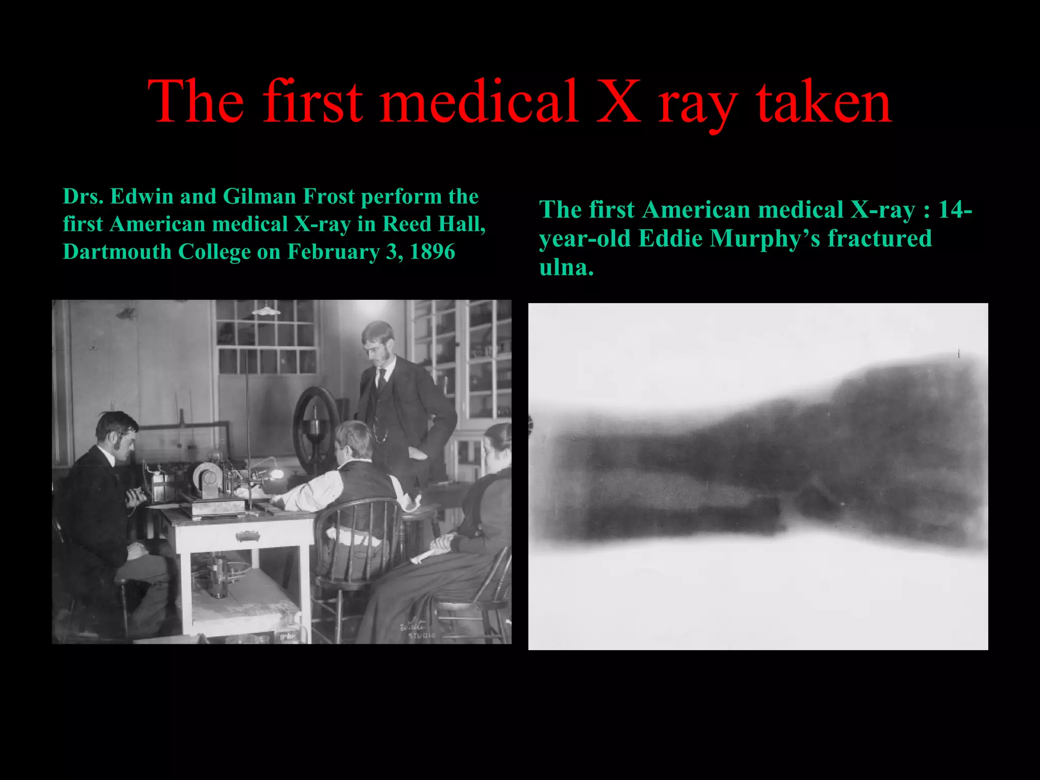 The first medical X ray taken 
Drs. Edwin and Gilman Frost perform the 
first American medical X-ray in Reed Hall, 
Dartmouth College on February 3, 1896 
The first American medical X-ray : 14- 
year-old Eddie Murphy’s fractured 
ulna. 
 