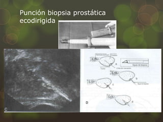 Punción biopsia prostática 
ecodirigida 
 