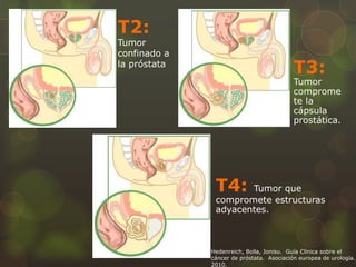 T2: 
Tumor 
confinado a 
la próstata T3: 
Tumor 
comprome 
te la 
cápsula 
prostática. 
T4: Tumor que 
compromete estructuras 
adyacentes. 
Hedenreich, Bolla, Jonisu. Guía Clínica sobre el 
cáncer de próstata. Asociación europea de urología. 
2010. 
 
