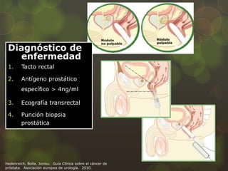 Diagnóstico de 
enfermedad 
1. Tacto rectal 
2. Antígeno prostático 
específico > 4ng/ml 
3. Ecografía transrectal 
4. Punción biopsia 
prostática 
Hedenreich, Bolla, Jonisu. Guía Clínica sobre el cáncer de 
próstata. Asociación europea de urología. 2010. 
 