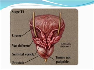 Ca prostate