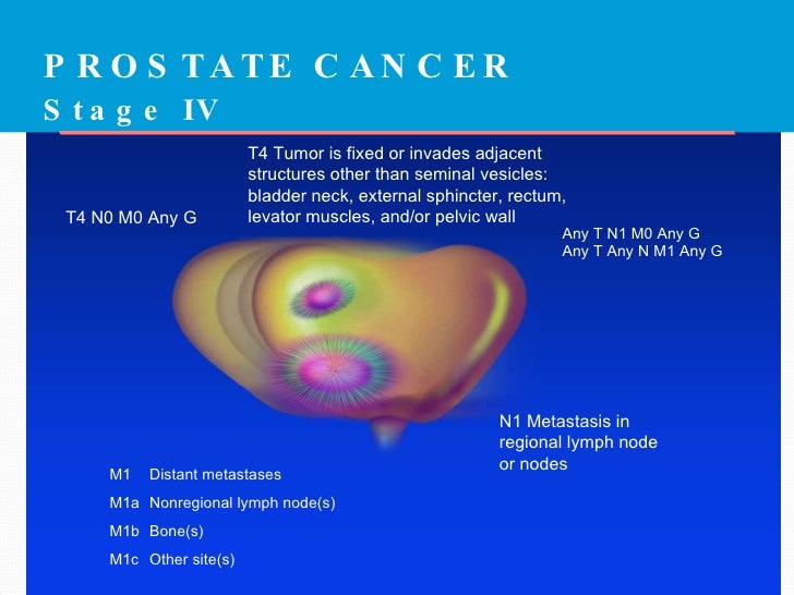 Ca prostate
