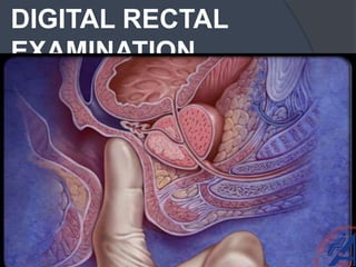 DIGITAL RECTAL
EXAMINATION
 
