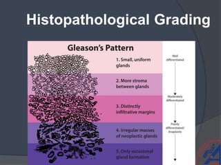 Histopathological Grading
 