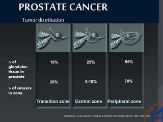 PROSTATE CANCER
Tumor distribution
% of
glandular
tissue in
prostate
% of cancers
in zone
10% 25% 65%
5-10% 70%20%
Oesterling J, et al. Cancer: Principles & Practice of Oncology. 5th ed. 1997;1322-1386.
Transition zone Central zone Peripheral zone
 
