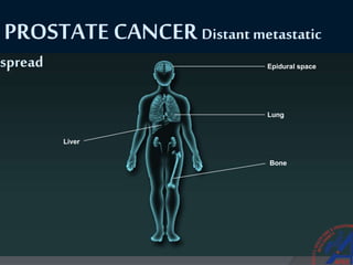 Lung
Bone
Liver
Epidural space
PROSTATE CANCER Distant metastatic
spread
 