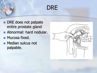 DRE
 DRE does not palpate
entire prostate gland
 Abnormal: hard nodular.
 Mucosa fixed.
 Median sulcus not
palpable.
 