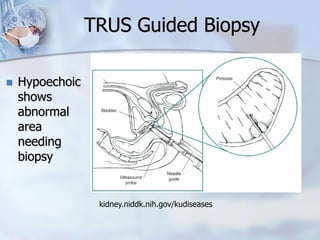 kidney.niddk.nih.gov/kudiseases
TRUS Guided Biopsy
 Hypoechoic
shows
abnormal
area
needing
biopsy
 