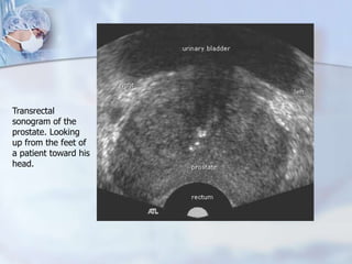 Transrectal
sonogram of the
prostate. Looking
up from the feet of
a patient toward his
head.
 