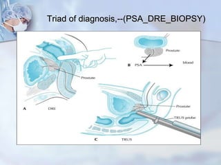 Triad of diagnosis,--(PSA_DRE_BIOPSY)
 
