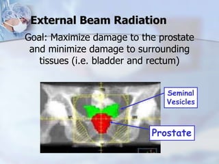 External Beam Radiation
Goal: Maximize damage to the prostate
and minimize damage to surrounding
tissues (i.e. bladder and rectum)
Prostate
Seminal
Vesicles
 