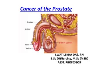 Cancer of the Prostate
SWATILEKHA DAS, RN
B.Sc (H)Nursing, M.Sc (MSN)
ASST. PROFESSOR
 