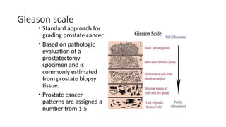 Prostate Risk Scale CA Prostate PowerPoint presentation surgery | PPTX