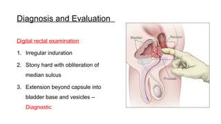 carcinoma prostrate , epidemiology, treatment | PPTX