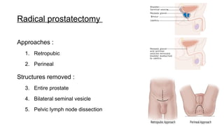 Prostrate Node carcinoma prostrate , epidemiology, treatment | PPTX