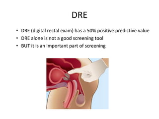 DRE
• DRE (digital rectal exam) has a 50% positive predictive value
• DRE alone is not a good screening tool
• BUT it is an important part of screening
 