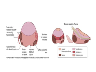 Transrectal ultrasound appearances suspicious for cancer
 