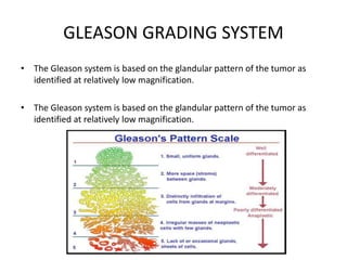 GLEASON GRADING SYSTEM
• The Gleason system is based on the glandular pattern of the tumor as
identified at relatively low magnification.
• The Gleason system is based on the glandular pattern of the tumor as
identified at relatively low magnification.
 
