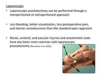 Laparoscopic
• Laparoscopic prostatectomy can be performed through a
transperitoneal or extraperitoneal approach.
• Less bleeding, better visualization, less postoperative pain,
and shorter convalescence than the standard open approach.
• Rectal, ureteral, and vascular injuries and anastomotic leaks
have also been more common with laparoscopic
prostatectomy (Rassweiler et al, 2003).
 