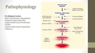 Carcinoma Of Prostate and its management | PPTX