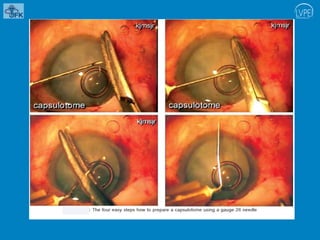 Capsular opening.pptx