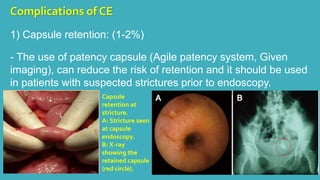 Patency Capsule Risks Capsule endoscopy | PPTX