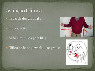  Início de dor gradual ;
 Piora a noite ;
 AdM diminuída para RE ;
 Dificuldade de elevação -120 graus;
 
