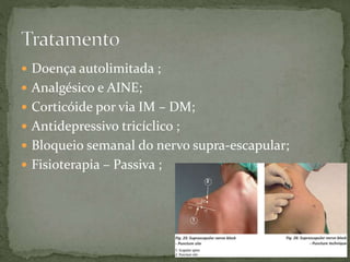  Doença autolimitada ;
 Analgésico e AINE;
 Corticóide por via IM – DM;
 Antidepressivo tricíclico ;
 Bloqueio semanal do nervo supra-escapular;
 Fisioterapia – Passiva ;
 