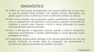 DIAGNÓSTICO
 A RM é um meio auxiliar de diagnóstico não-invasivo efetivo não só para casos
em que há suspeita desta condição, mas também fornece informações que
podem ajudar o clínico a diferenciar entre os diferentes estádios da doença.
 Entre outros achados, são visualizáveis aspetos característicos desta condição
como: o espessamento do ligamento coracoumeral e capsular no intervalo dos
rotadores e recesso axilar (superior a 4mm) e ainda obliteração do espaço
subcoracoide pela cápsula espessada .
 Assim, a RM permite o diagnóstico precoce quando a clínica é inespecífica,
determinar possivelmente o estádio patofisiológico e ainda descartar outras
patologias do ombro.
 O diagnóstico precoce desta patologia é de extrema importância uma vez que
permite instituição de terapia antes da progressão do espessamento e
contratura da cápsula observados em estádios avançados.
A. Pimentel,2011
 